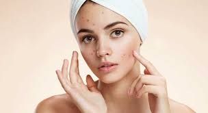 acne treatment pune